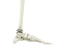 Total Ankle Joint Replacement