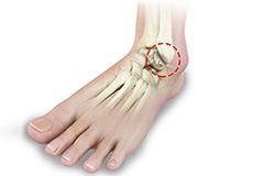 Arthritis of the Foot & Ankle