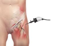 Hip Arthroscopy