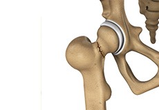 Hip Fracture