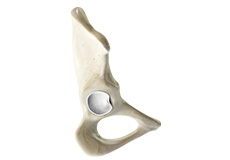 Hip Labral Tear