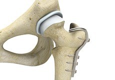 Hip Osteotomy