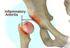 Inflammatory Arthritis