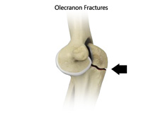Olecranon Fracture