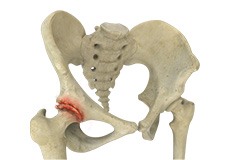 Osteoarthritis of the Hip