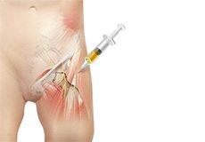 Platelet-rich Plasma (PRP) for Hip Pain